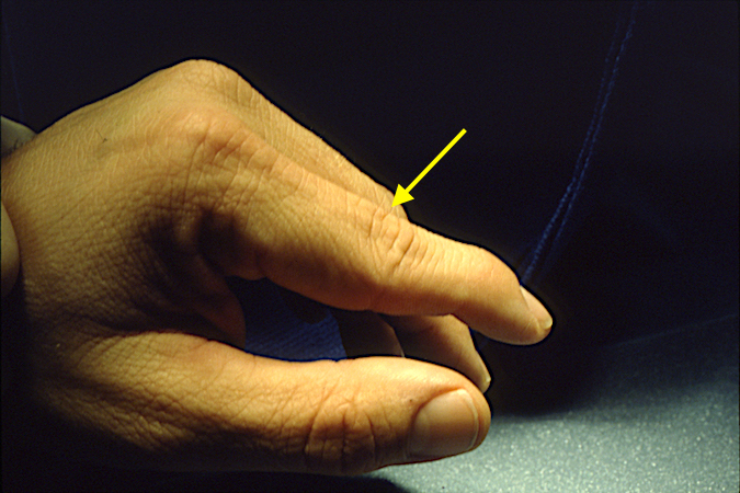 swan-neck-deformity-hand-surgery-resource